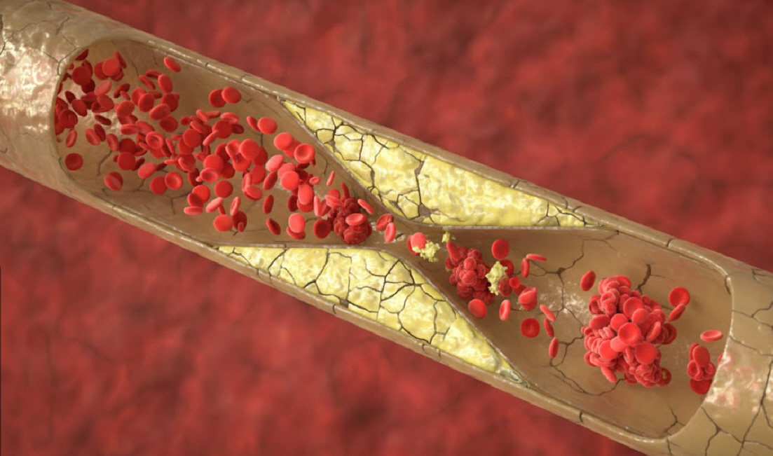 딱딱해게 굳어 플라스틱 파이프처럼 보이는 혈관 이미지